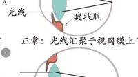 高度近视觉得自己人生都无望了我还是个女孩纸，怎么办？