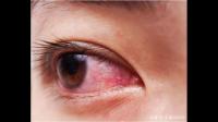 眼睛通红可能是哪些原因导致？