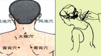怎么能让颈椎病好起来？